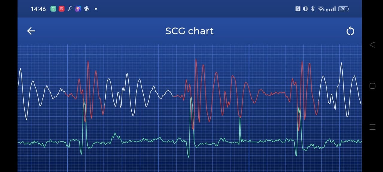 Synchronous recording ECG+SCG