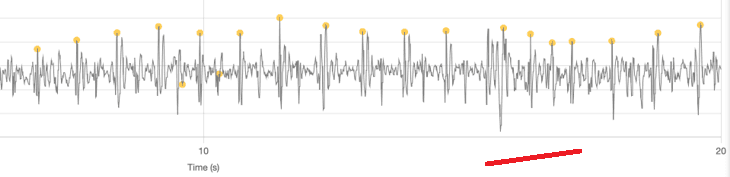 Sinus tachycardia